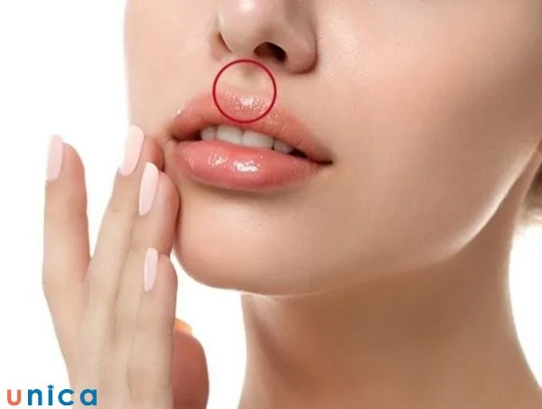 Nhân trung đỏ tía