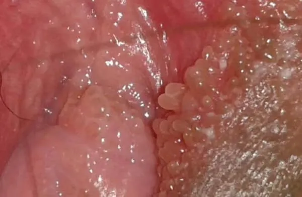 Nốt sùi mào gà trong âm đạo