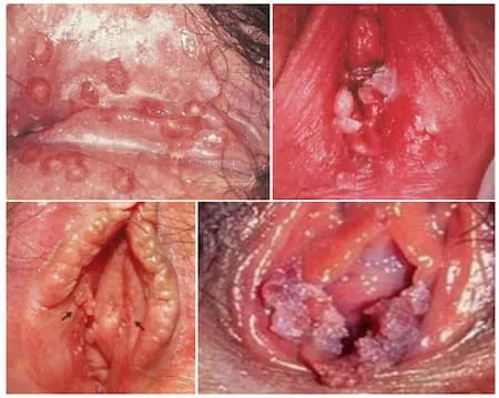 Sùi mào gà ở âm đạo