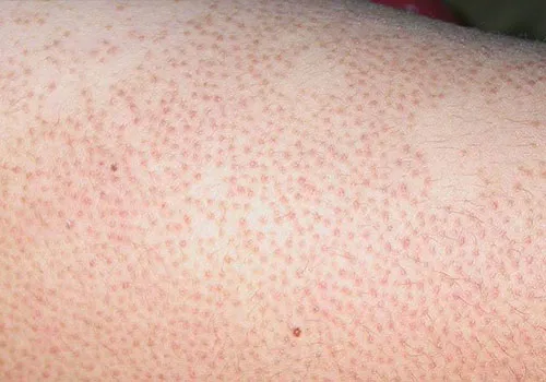 Viêm nang lông vùng kín