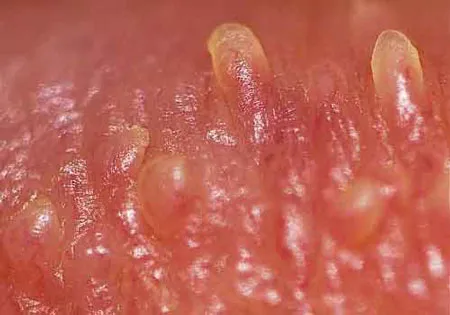 Gai sinh dục ở nữ