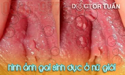 Gai sinh dục ở nữ giới