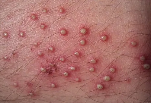 Mọc mụn vùng kín