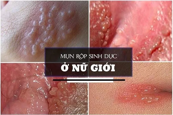 Mụn rộp sinh dục ở nữ