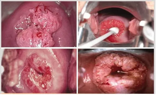 Sùi mào gà ở cổ tử cung