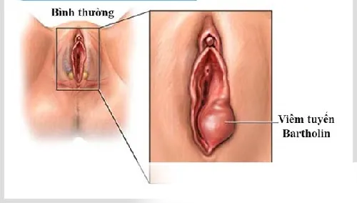 Hình ảnh u tuyến Bartholin