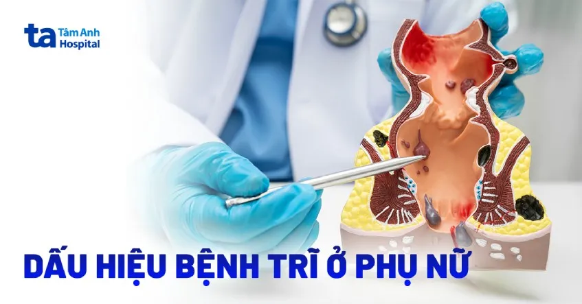 dấu hiệu bệnh trĩ ở phụ nữ