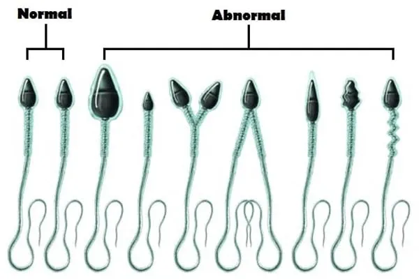 Hình ảnh mô phỏng sự khác biệt giữa tinh binh khỏe mạnh và các dạng bất thường