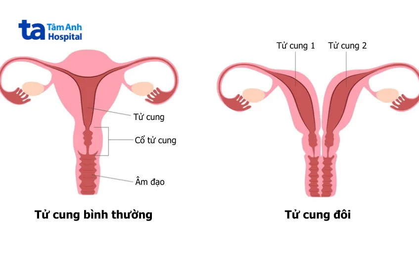 Hình ảnh minh họa dị tật tử cung đôi ở phụ nữ