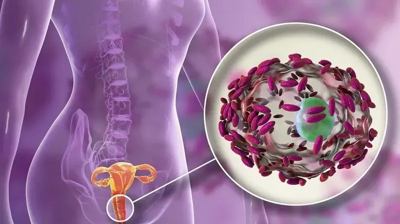 Viêm âm đạo do vi khuẩn thường gây ra khí hư màu bất thường và có mùi tanh khó chịu