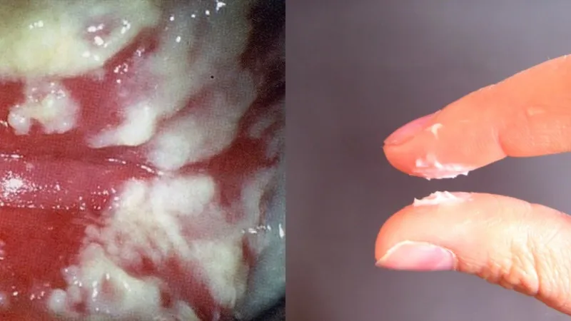 Viêm phụ khoa do nấm Candida đặc trưng bởi khí vón cục như bã đậu và ngứa rát vùng kín