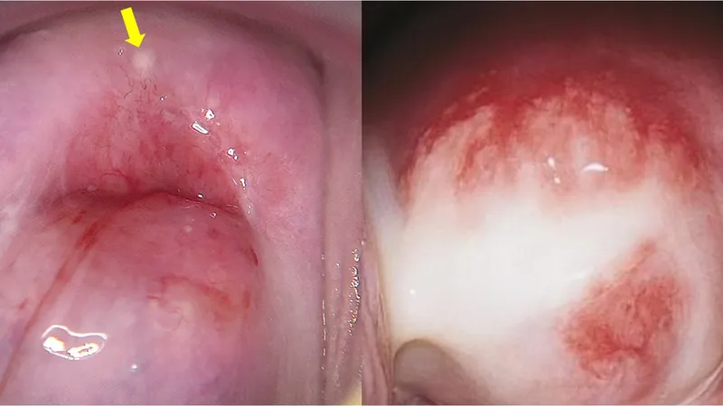 Cổ tử cung sưng đỏ, khí hư có mủ và mùi hôi nặng là dấu hiệu của viêm cổ tử cung