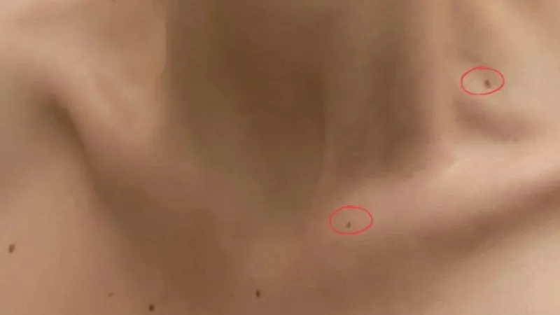 Tẩy nốt ruồi cần thực hiện tại cơ sở uy tín