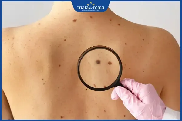 Vị trí nốt ruồi ở sau lưng phụ nữ dự báo tương lai