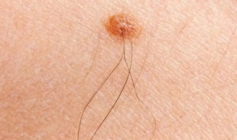 Cách xử lý an toàn cho tướng phụ nữ có lông ở nhũ hoa