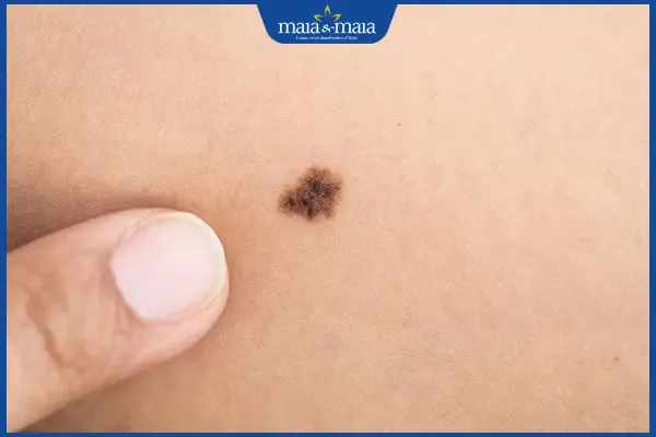 Nhận biết nốt ruồi bất thường trên trán phụ nữ để bảo vệ sức khỏe