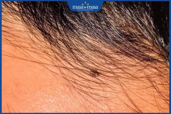 Tướng nốt ruồi cung thiên di thể hiện sự dịch chuyển và thành công lớn