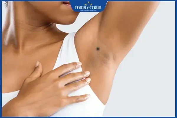 Nốt ruồi nách trái nữ giới