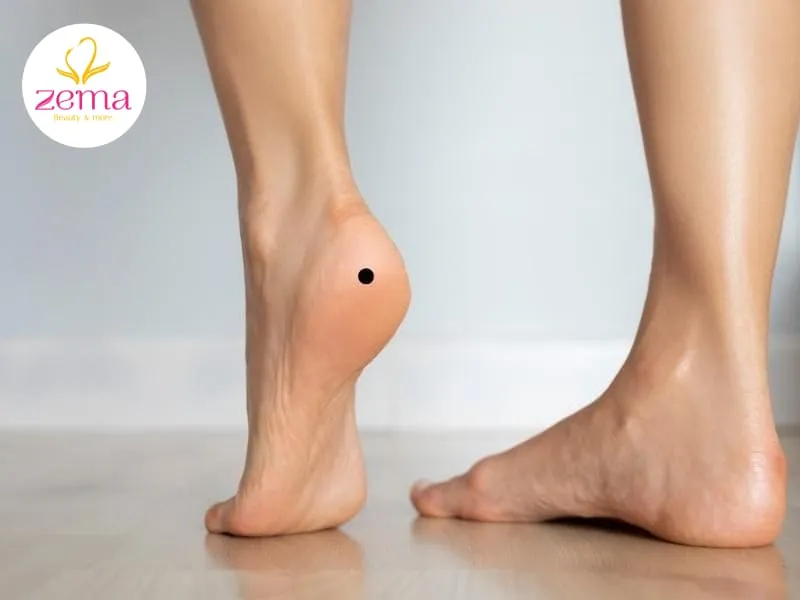 Nốt ruồi ở gót chân là nốt ruồi tốt vì nằm trên vị trí phúc tướng