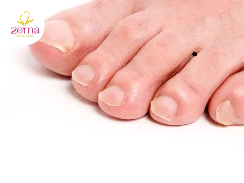 Người có nốt ruồi ở kẽ chân thường có cuộc sống giàu có