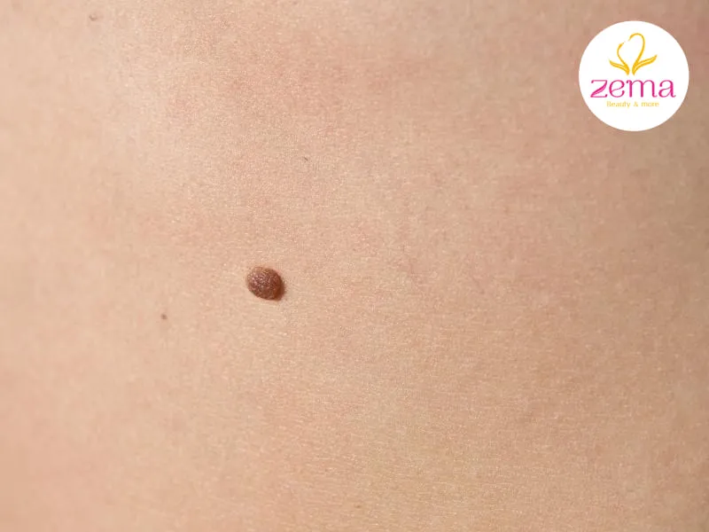 Nốt ruồi có nên tẩy hay không tùy thuộc vào quan điểm và quyết định của mỗi người