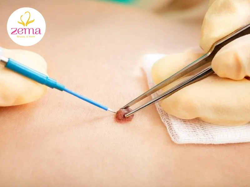 Nên tẩy nốt ruồi tại những cơ sở có uy tín và có các chuyên gia tẩy nốt ruồi